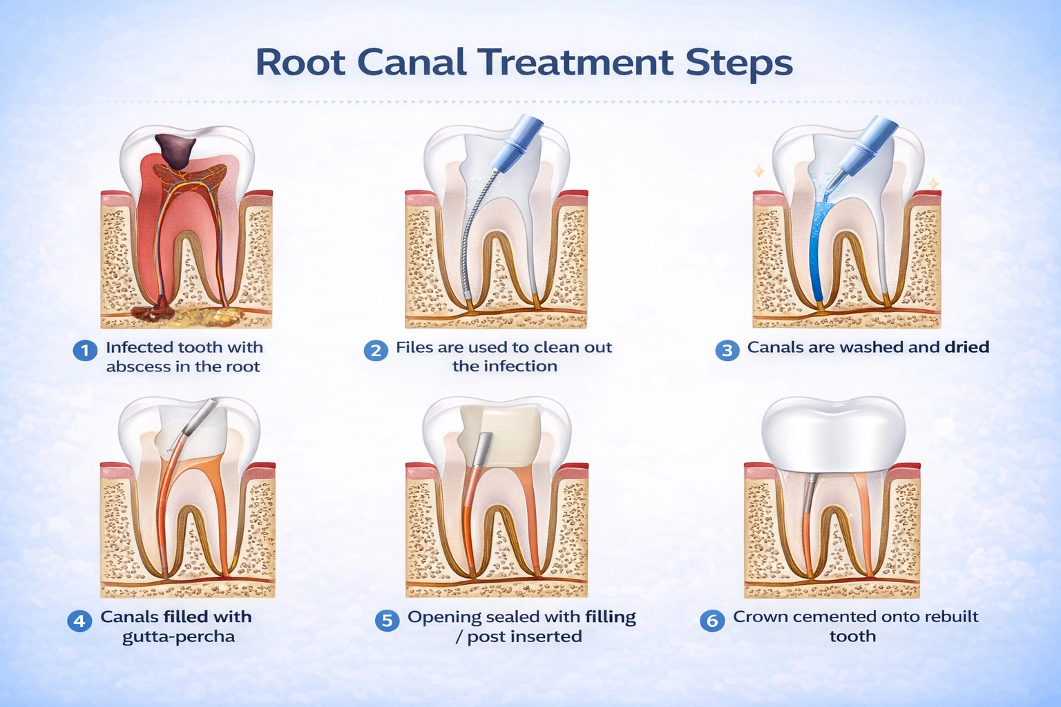 Root canal treatment steps infographic